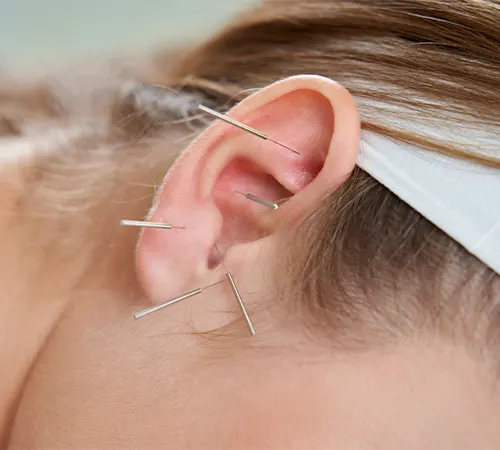 Auricular Acupuncture
