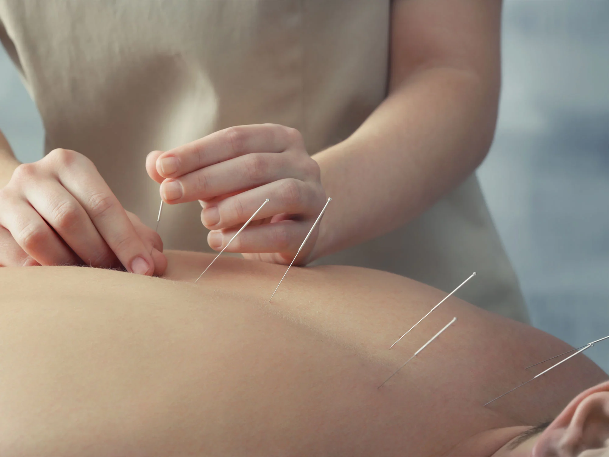 Acupuncture