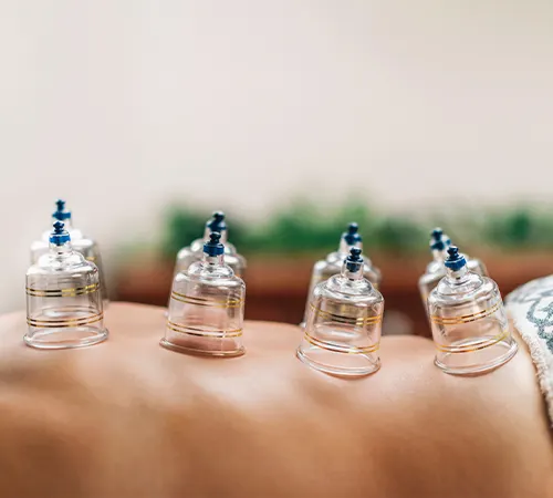 Cupping