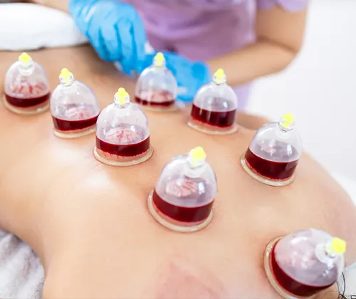 Hijama